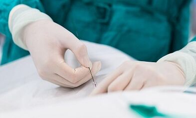 Diagnostika kŕčových žíl malej panvy