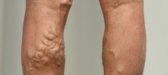 kŕčové žily na nohe