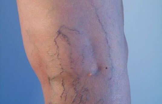 kŕčové žily na nohách u žien