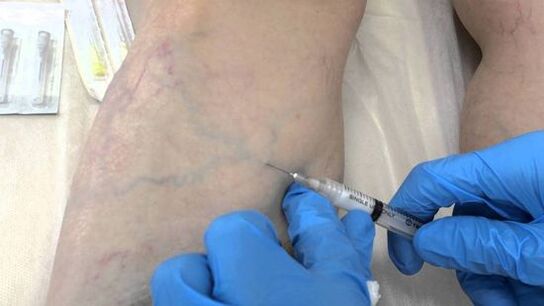 skleroterapia na kŕčové žily na nohách u žien