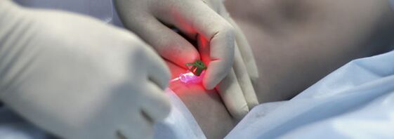 Odstránenie žily na nohe pomocou laserovej koagulácie